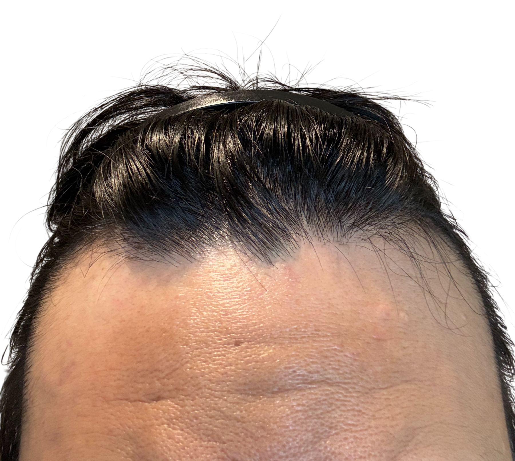 頭頂部