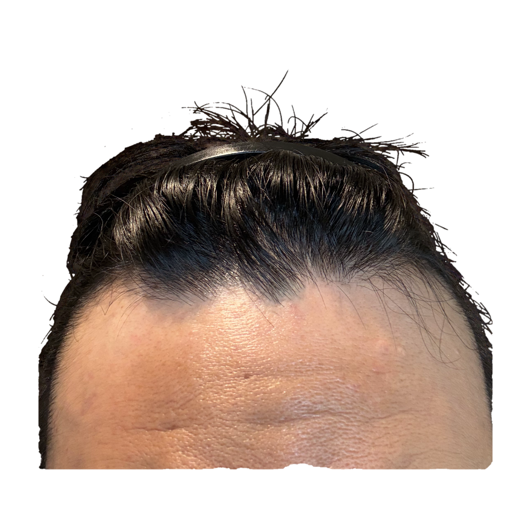 頭頂部